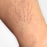 arañitas en miembros inferiores