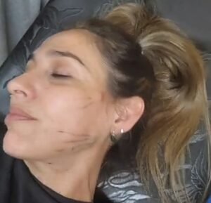 Bioestimuladores Dra. Soledad Ruvira