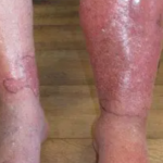 celulitis infecciosa