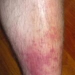 flebitis en miembro inferior