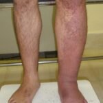 linfedema