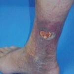 ulcera en miembro inferior