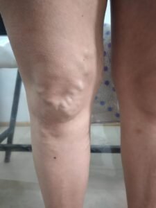 Grandes vasos Várices Dra. Soledad Ruvira